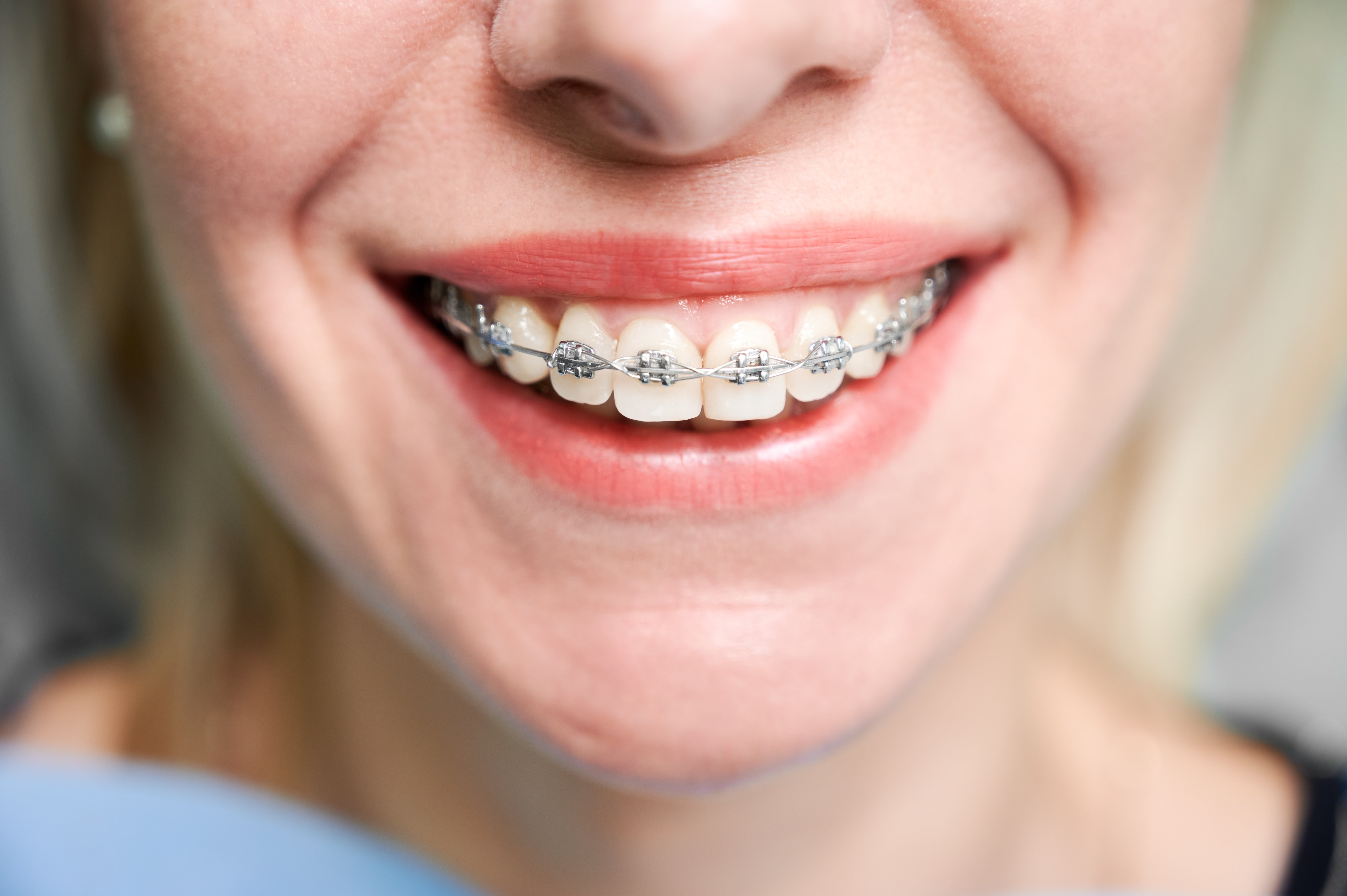 Dental Braces & Aligners