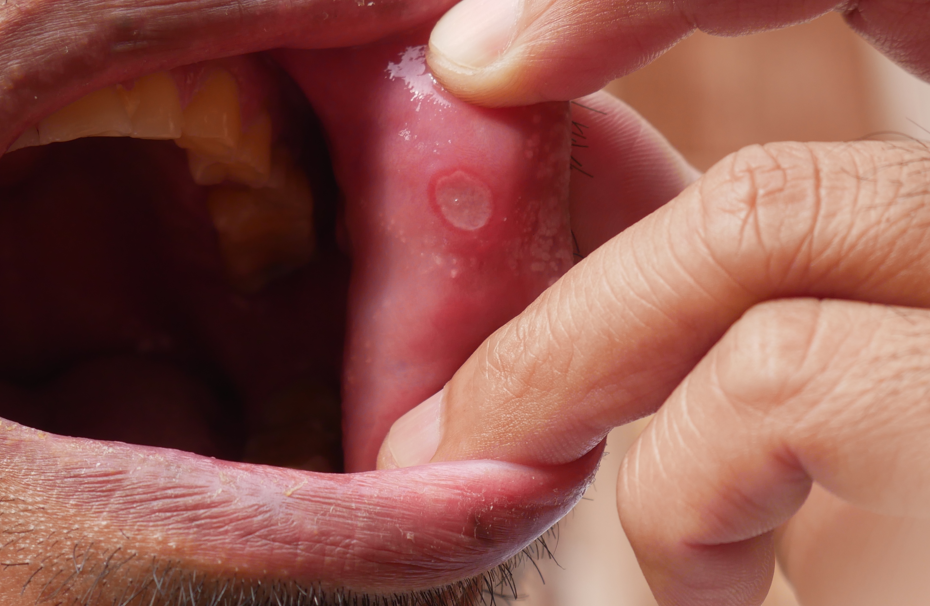 Mouth Ulcers
