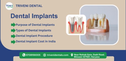 Dental Implants in India: Types ,Cost & Benefits