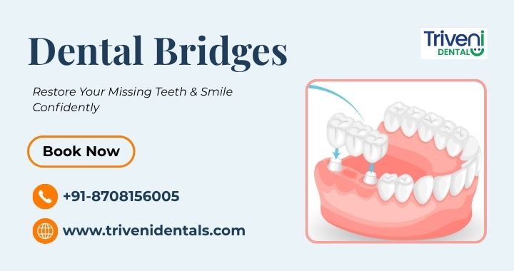 What Are Dental Bridges? Types, Need & Treatment Guide